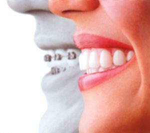 Invisalign Irvine Doctor2th