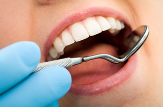 Composite Fillings in Irvine