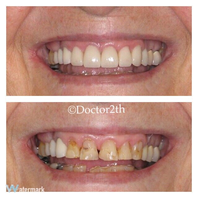 porcelain veneers dentist irvine ca